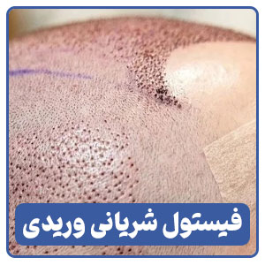 فیستول شریانی وریدی