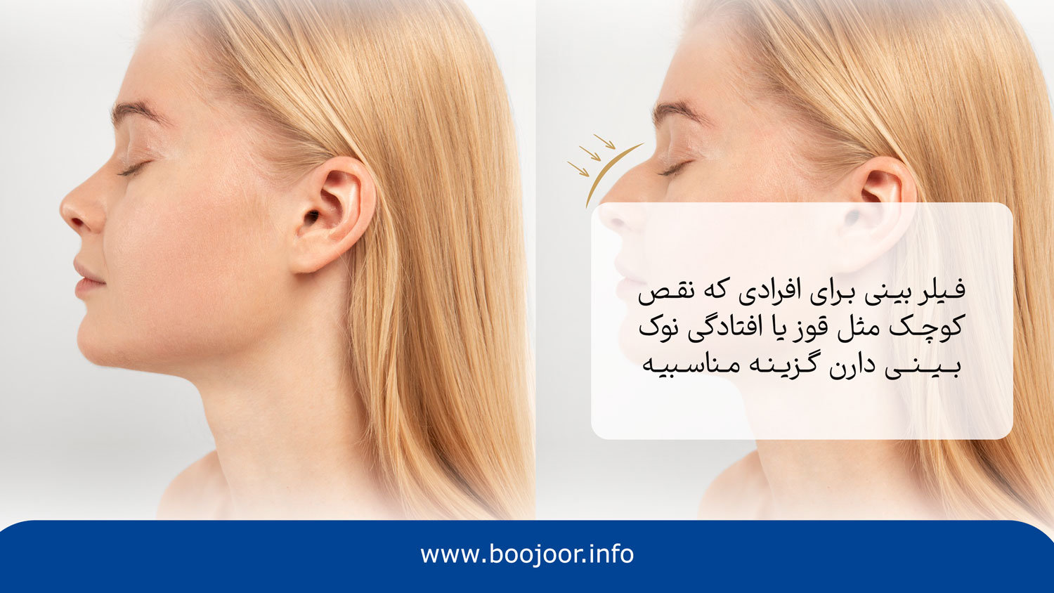 فیلر بینی برای چه کسانی مناسب است؟