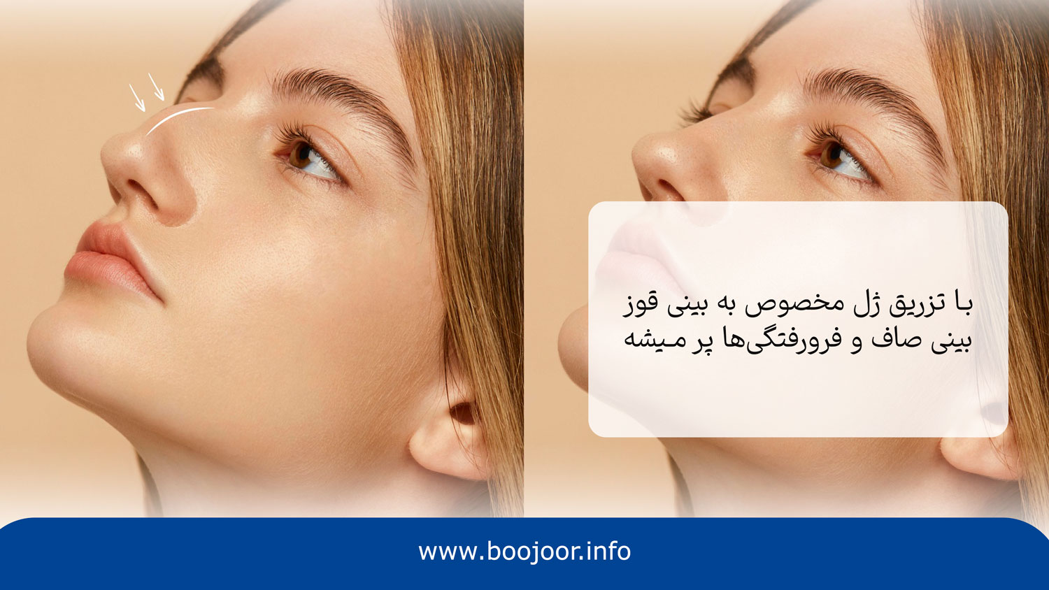 فیلر بینی چیست؟