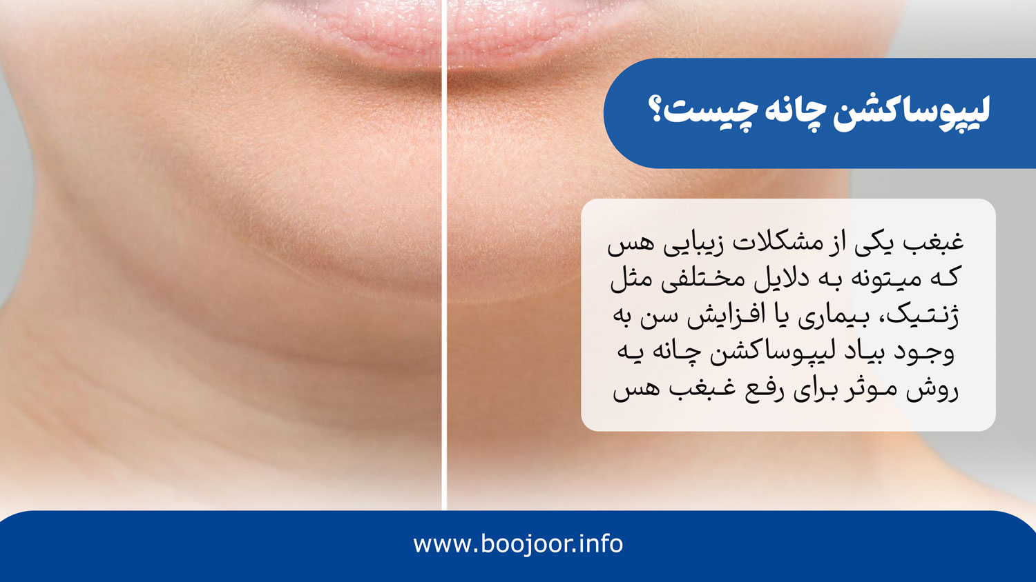 لیپوساکشن چانه چیست