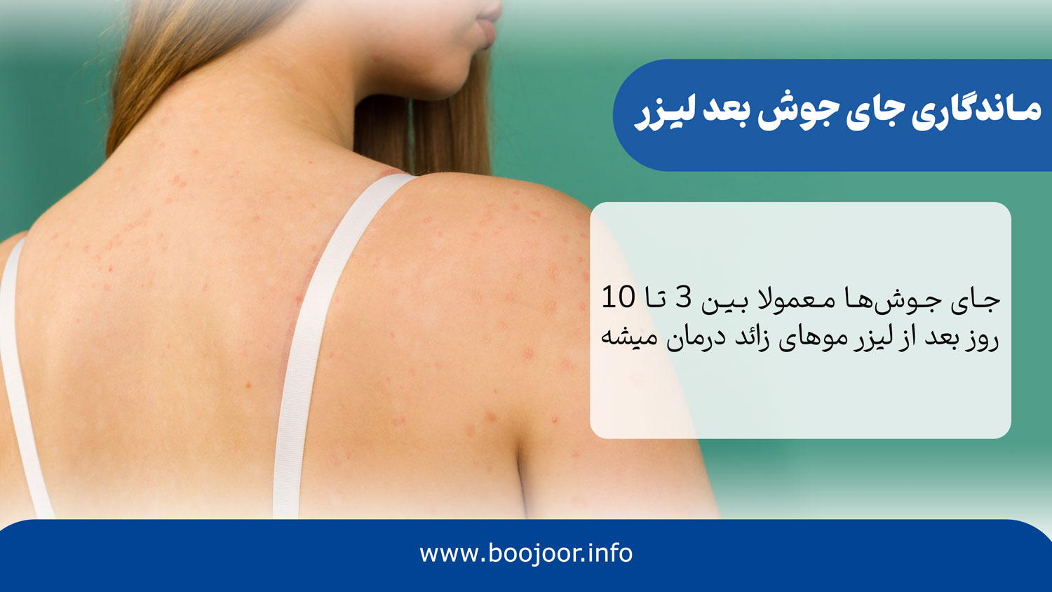 ماندگاری جای جوش بعد از لیزر