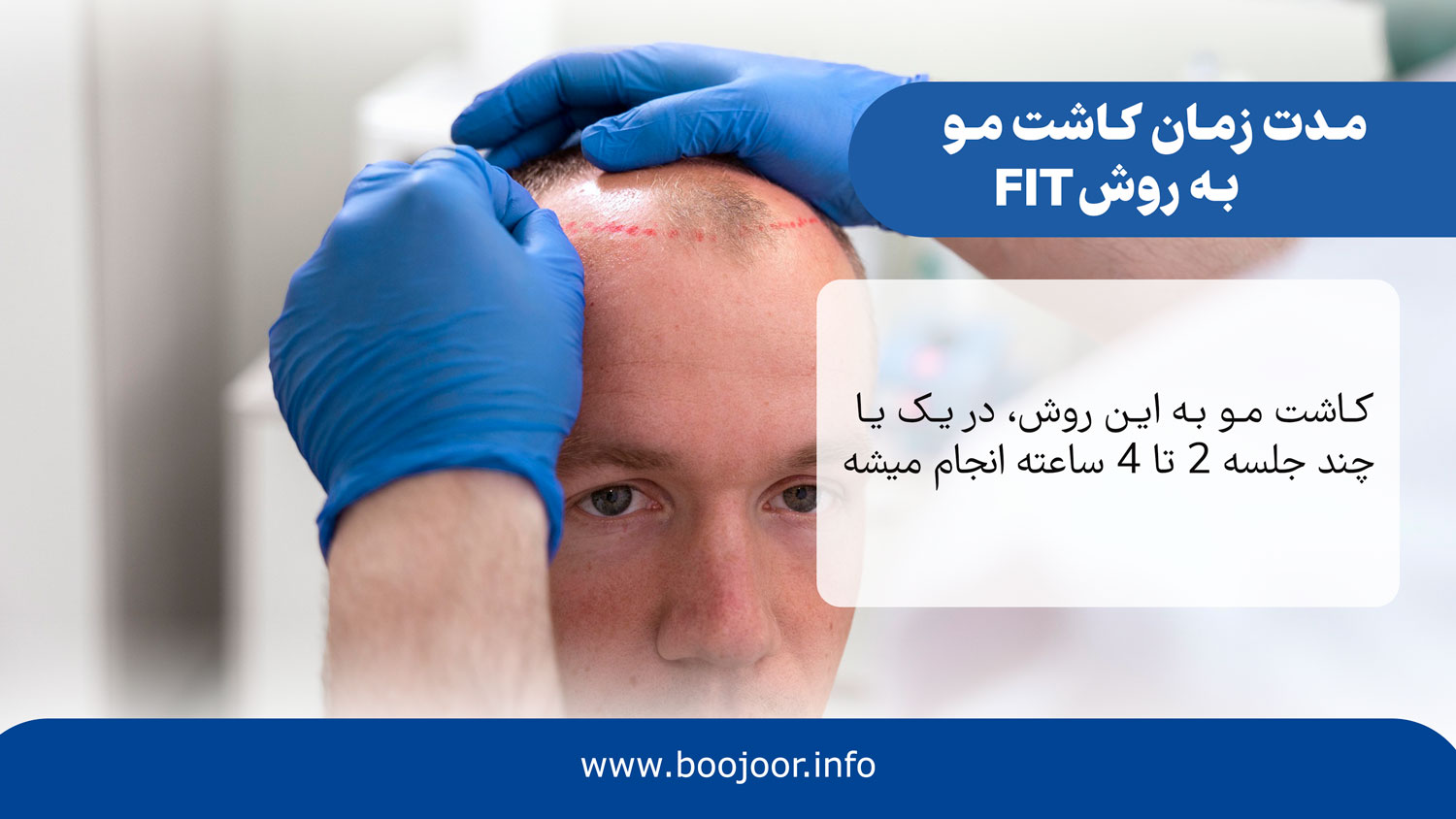 زمان کاشت مو به روش fit