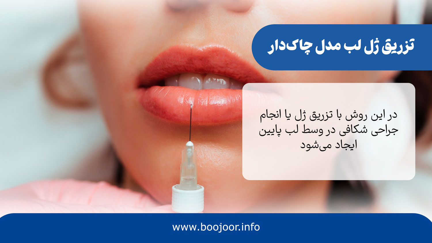 ژل لب مدل چاکدار