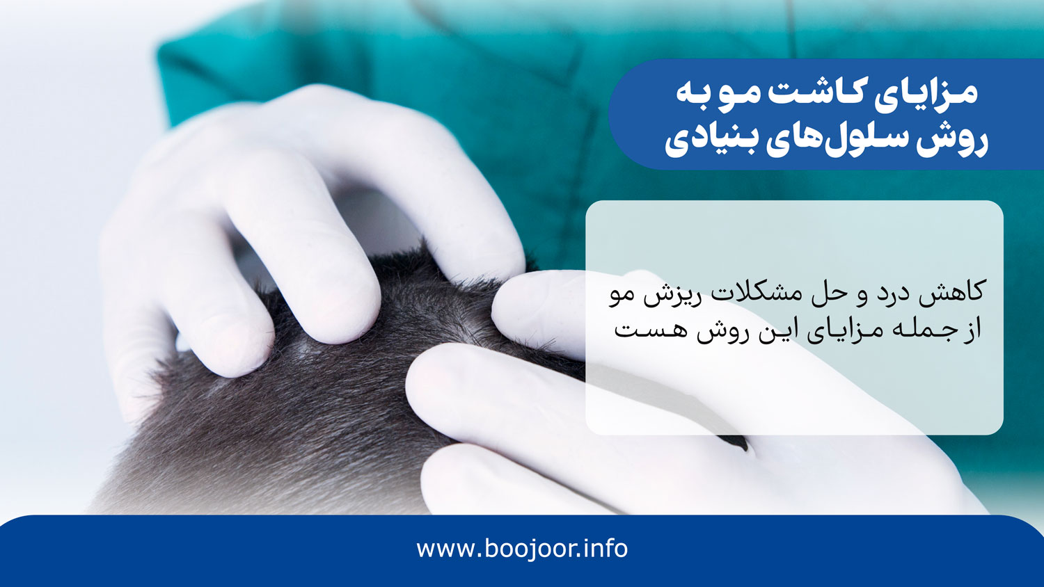 مزایای کاشت مو به روش سلول های بنیادی