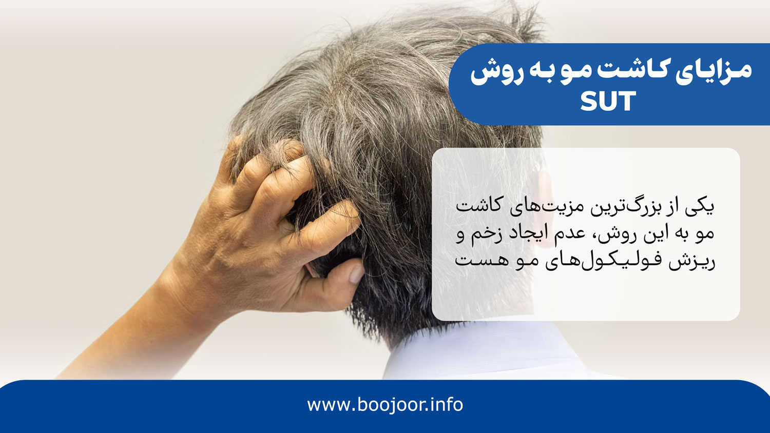 مزایای کاشت مو به روش sut