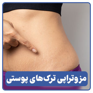 مزوتراپی برای از بین بردن ترک های پوستی در شیراز