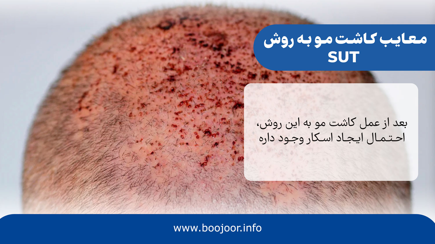 معایب کاشت مو به روش sut