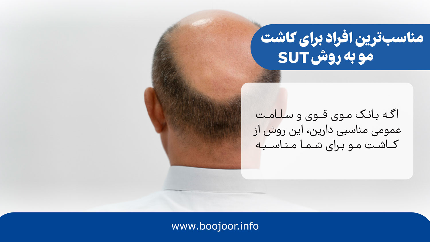 مناسبترین افراد برای کاشت مو به روش SUT
