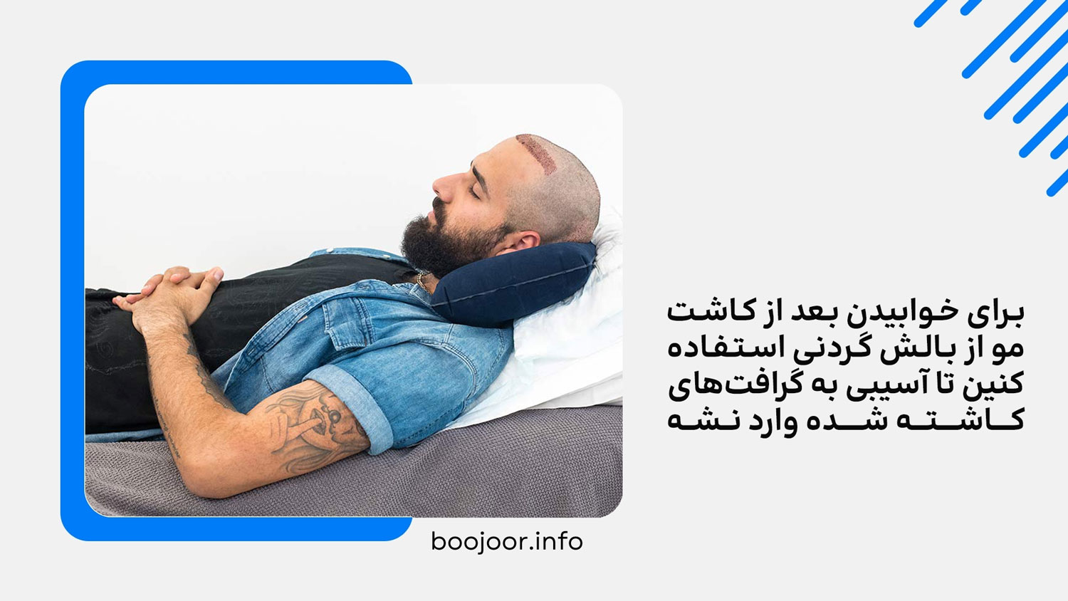 نحوه خوابیدن بعد از کاشت مو