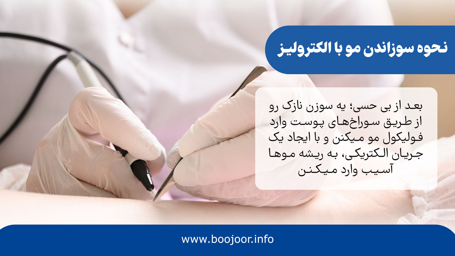 نحوه سوزاندن مو با الکترولیز