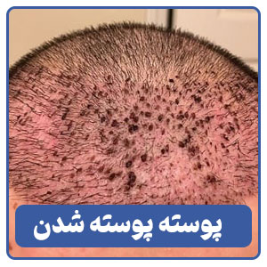 پوسته پوسته شدن