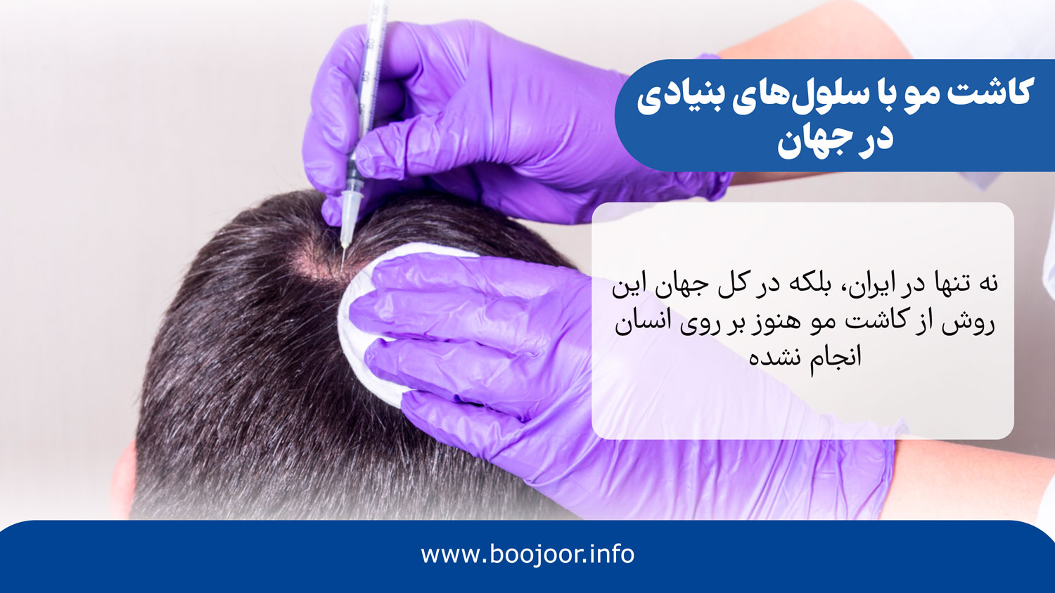 کاشت مو با سلول های بنیادی در جهان