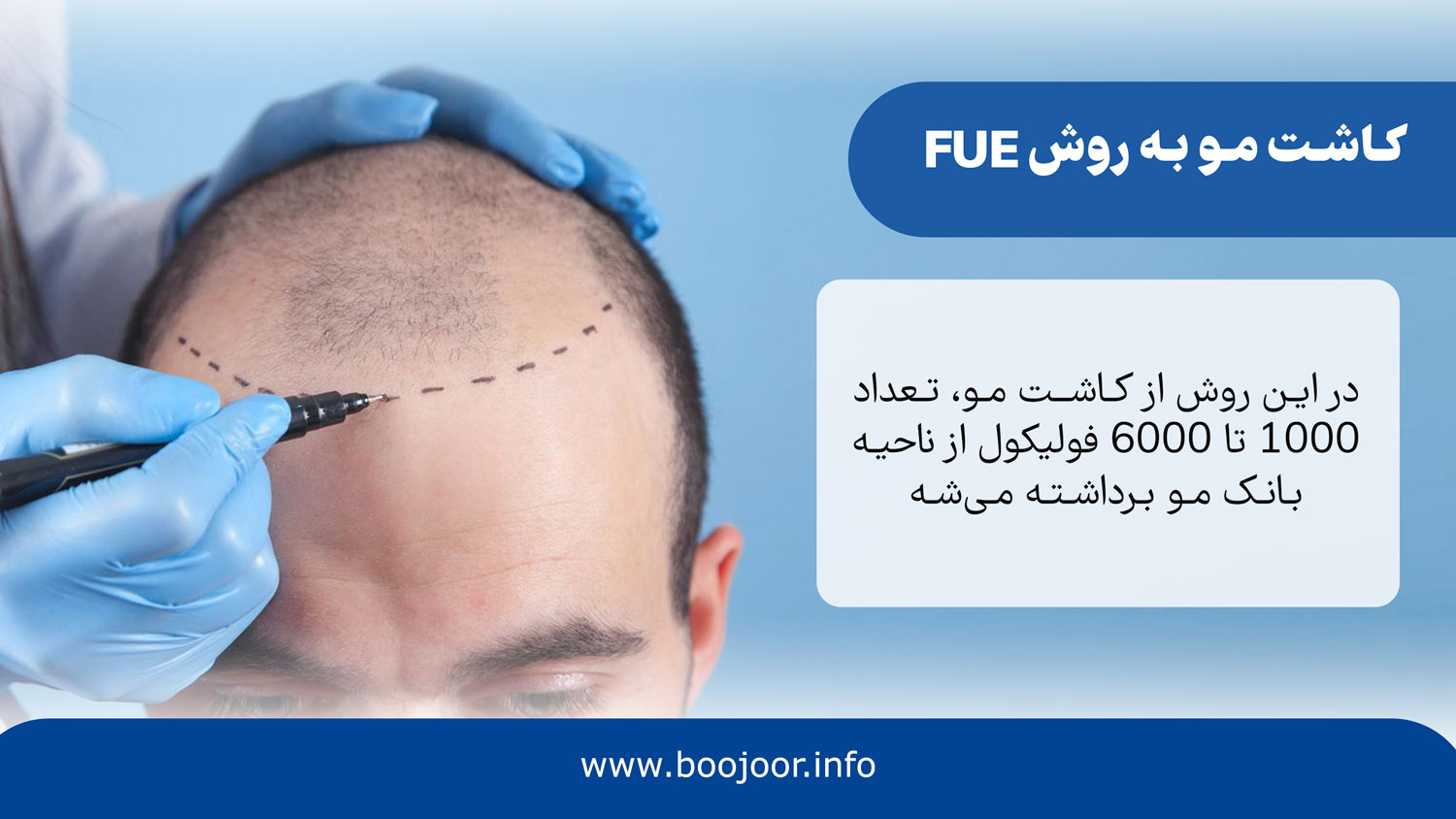 کاشت مو به روش FUE