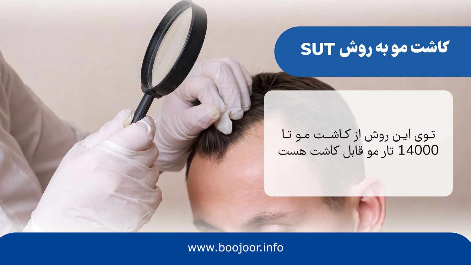 کاشت مو به روش sut