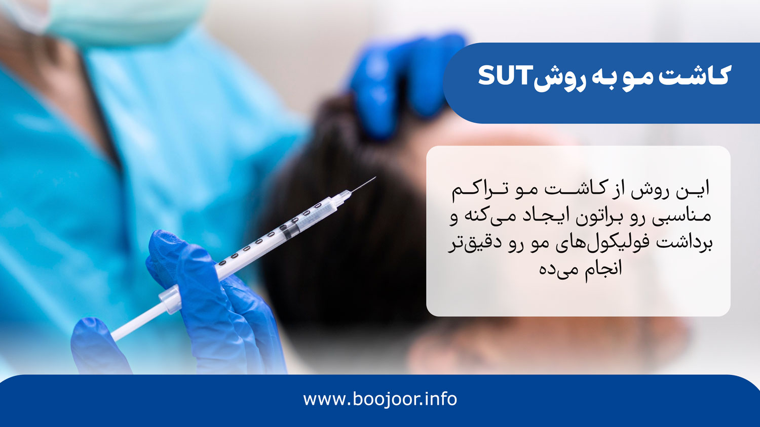 کاشت مو به روش SUT