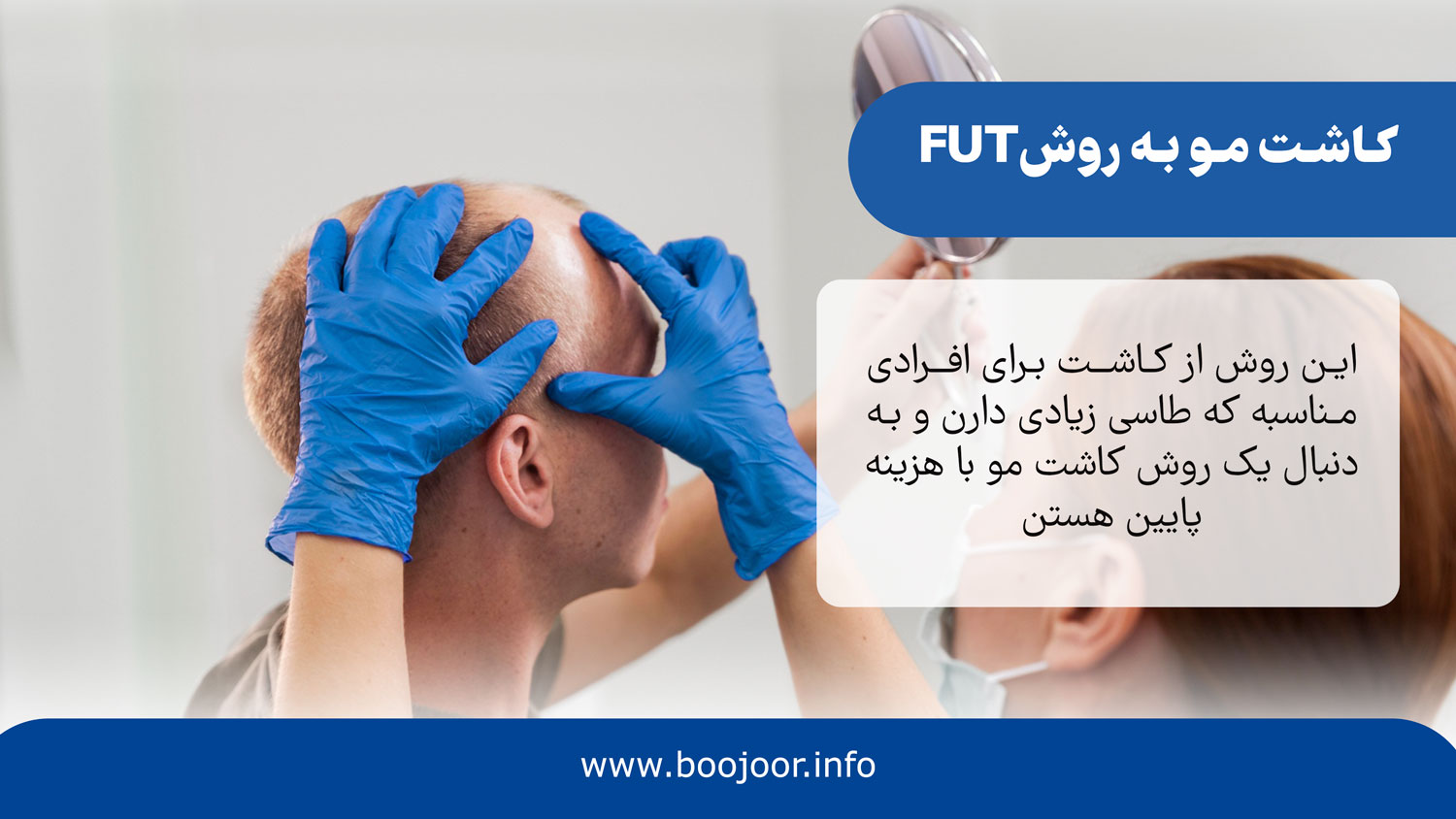 کاشت مو به روش fut