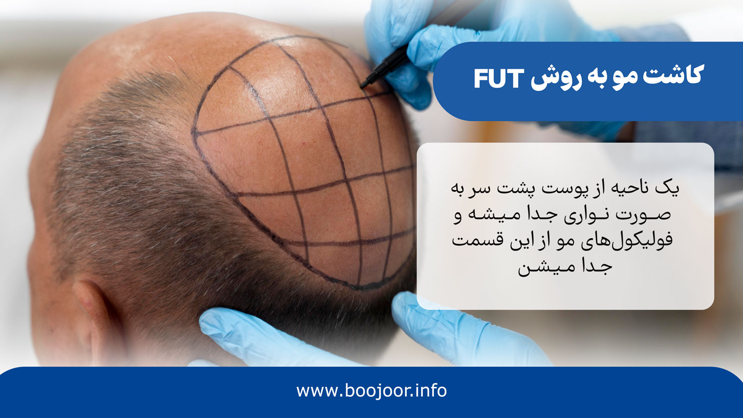 کاشت مو به روش fut