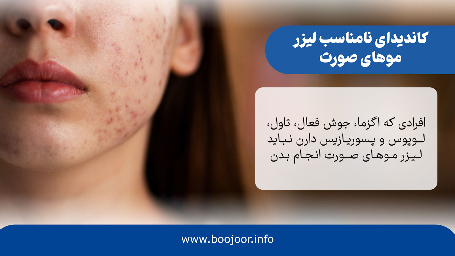کاندیدای نامناسی لیزر صورت