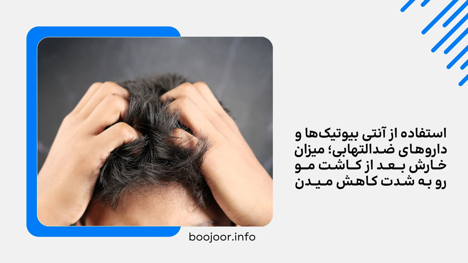 راهکار کاهش خارش بعد از کاشت مو