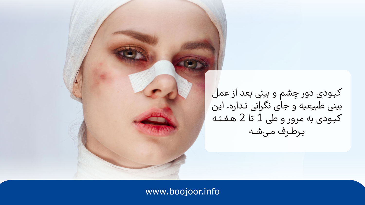 کبودی چشم بعد از عمل بینی در شیراز