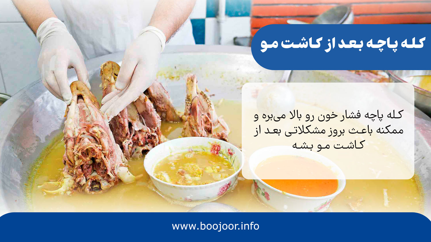 کله پاچه بعد از کاشت مو