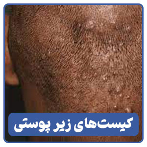 کیست های زیر پوستی