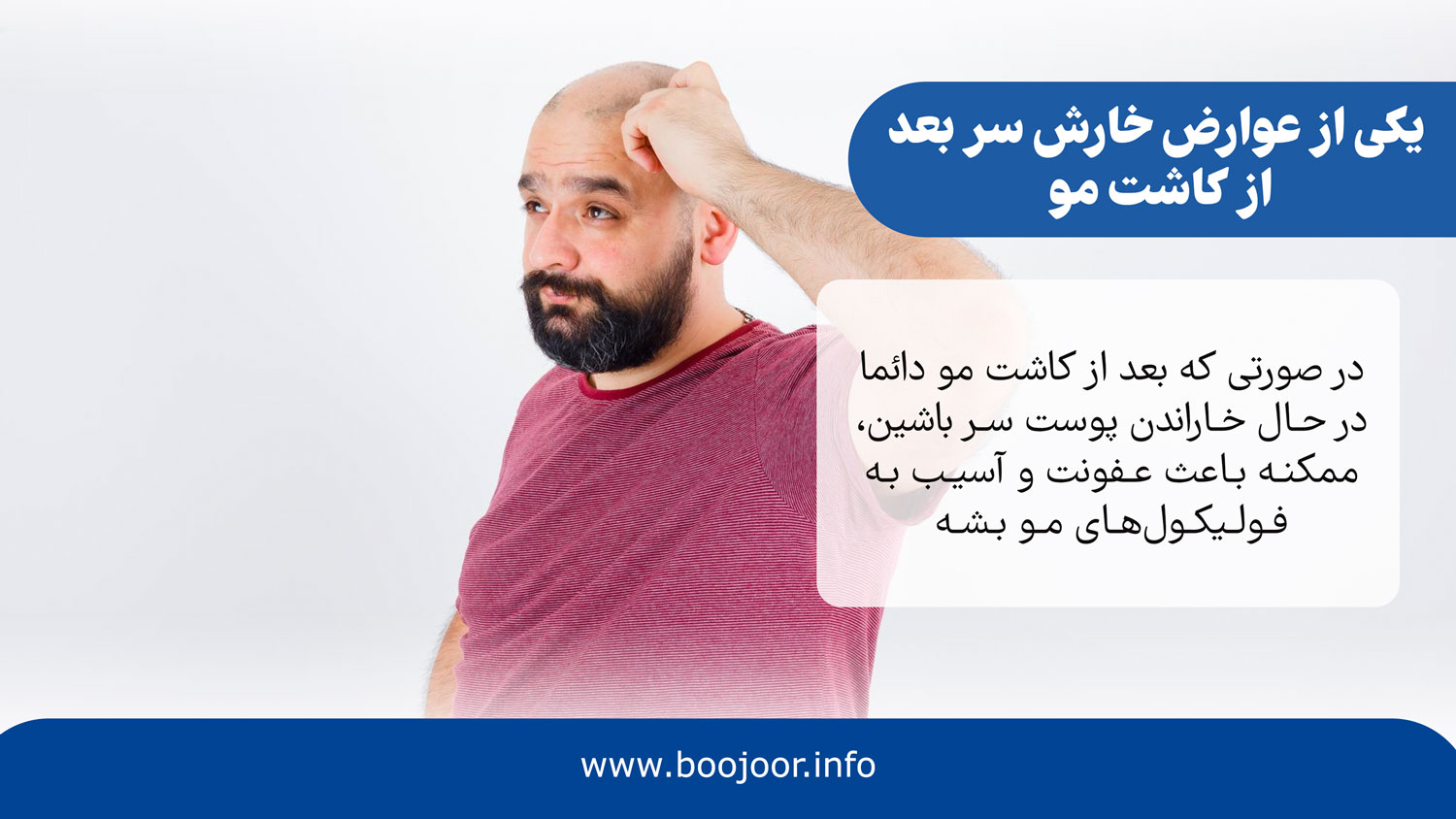 یکی از عوارض خارش سر بعد از کاشت مو