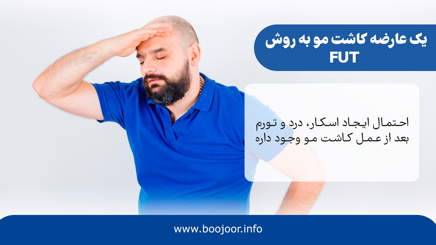 یک عارضه کاشت مو به روش fut