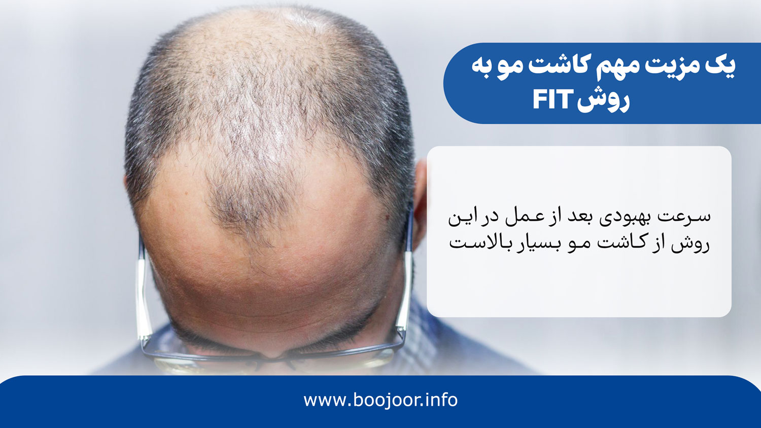مزایا کاشت مو به روش fit