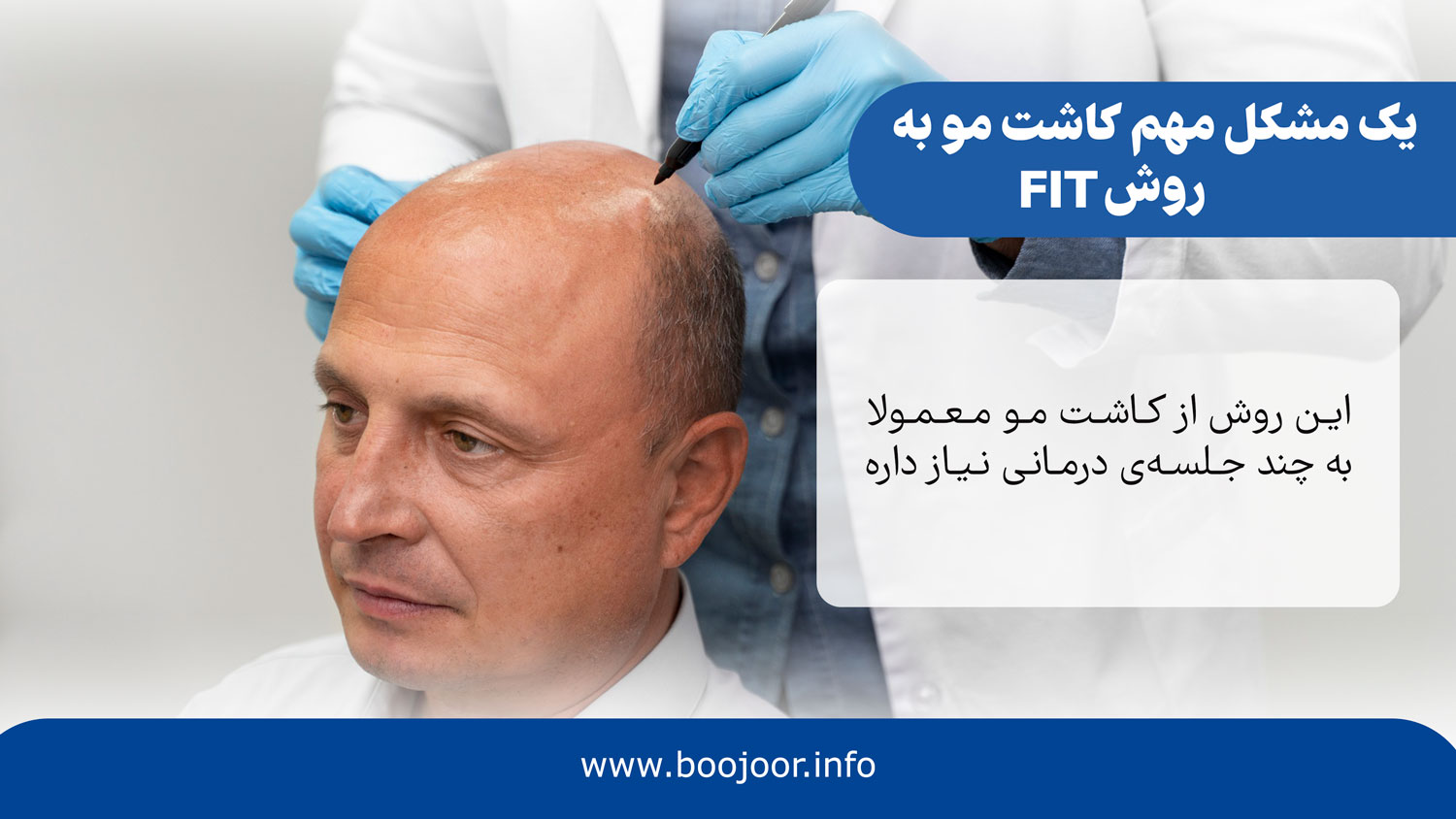 معایب کاشت مو به روش fit