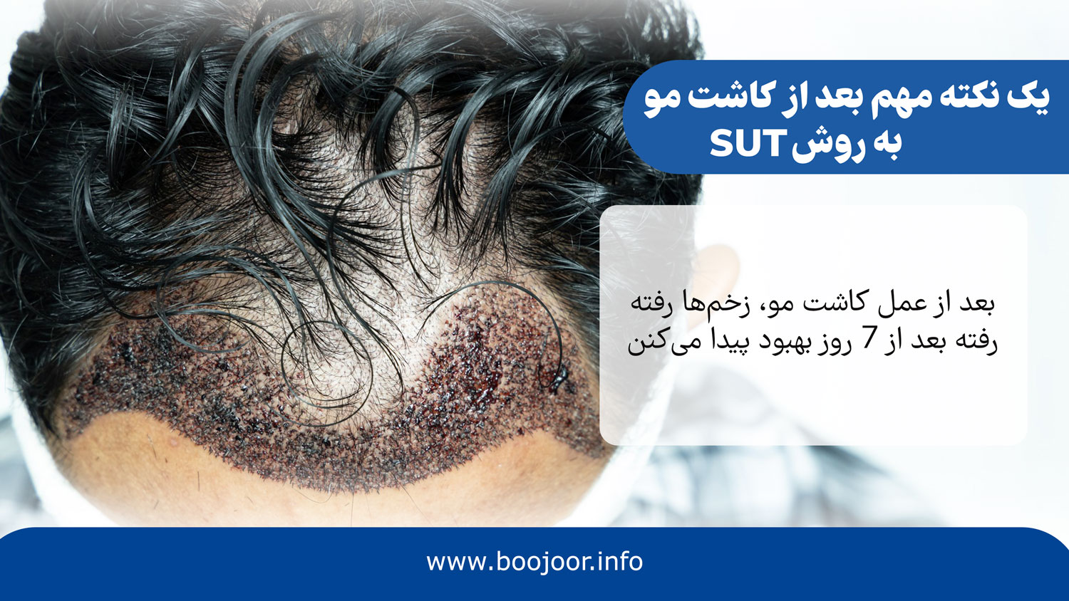 یک نکته مهم بعد از کاشت مو به روش sut